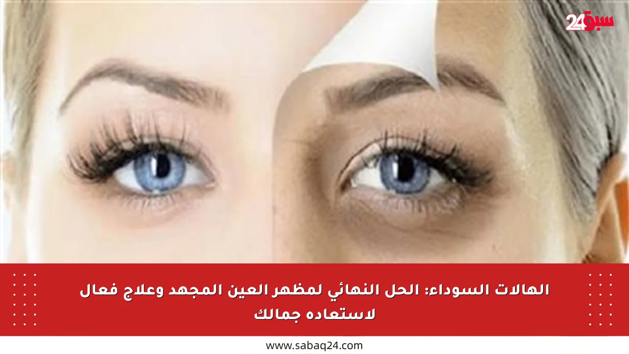 الهالات السوداء: الحل النهائي لمظهر العين المجهد وعلاج فعال لاستعادة جمالك